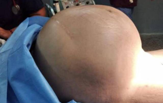 tumor