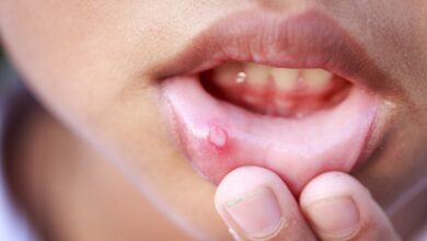 Conozca qué indican las llagas bucales