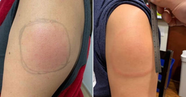 Vacuna contra el Covid-19 de Moderna deja picazón e hinchazón en el brazo