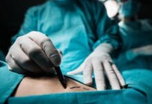 operacion