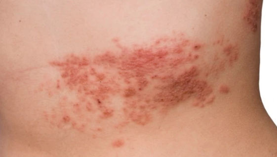 culebrilla